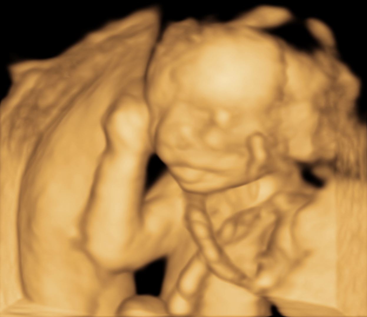 The Role of Three-Dimensional Ultrasound in Gynecology