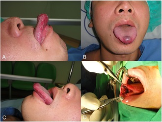 Mucocele of the Blandin-Nuhn Glands