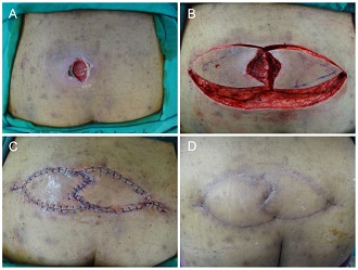 Double-Pacman Flap for a Small Sacral Defect