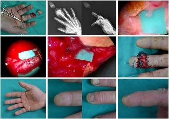 Fingertip (Tamai Zone I) Replantation under Local Anesthesia 