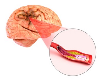 Stroke and sudden deafness