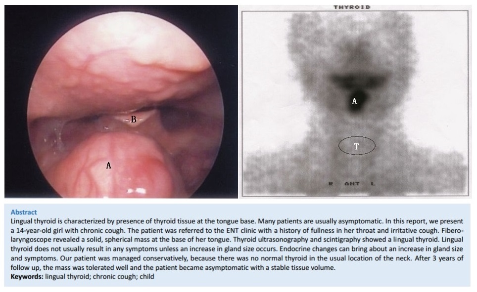 A Rare Cause of Chronic Cough in Children: Lingual Thyroid
